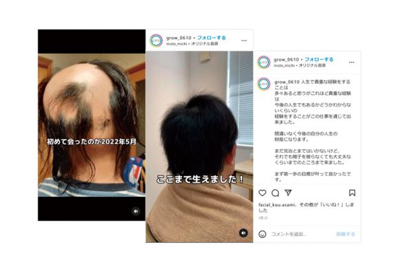 発毛は人生に関わり喜びをつくる仕事